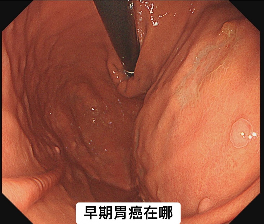 婦人胃內皺褶消失，經進一步檢查才得知是早期胃癌所致。（圖／翻攝自「胰臟醫師 林相宏 禾馨民權內科診所」臉書）