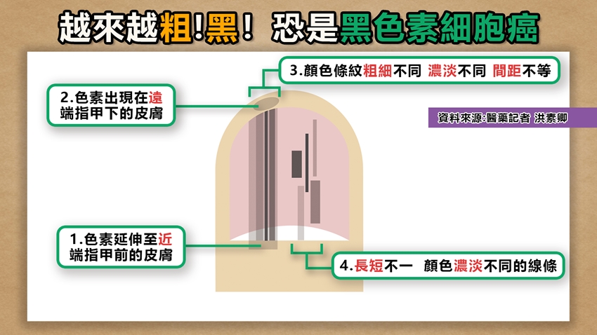 指甲出現4徵召務必盡速就醫。(圖/翻攝自健康2.0 YouTube)