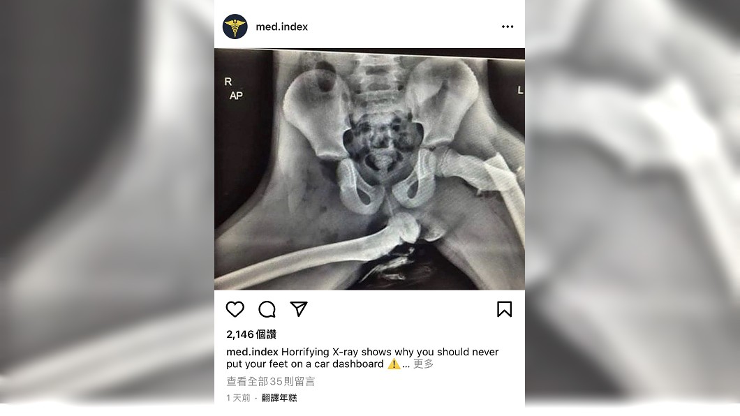 Med.index的貼文顯示如果把腳翹上儀錶台,車禍發生後受傷的嚴重程度。(圖片來源/ Instagram頻道 @Med.index)