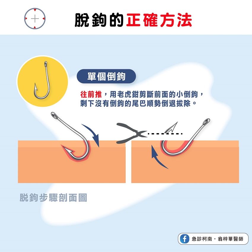 翁梓華教導正確的脫鉤步驟。(圖/翻攝自急診柯南.翁梓華醫師臉書)