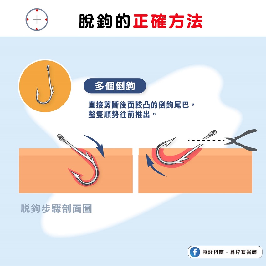 翁梓華教導正確的脫鉤步驟。(圖/翻攝自急診柯南.翁梓華醫師臉書)