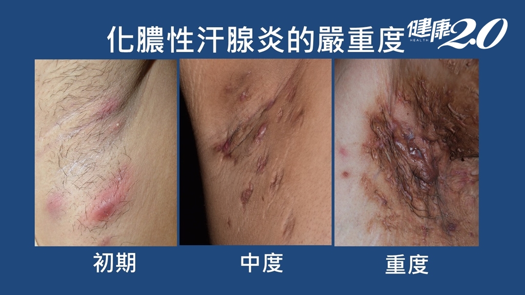 化膿性汗腺炎嚴重家度。(圖/成大醫院)