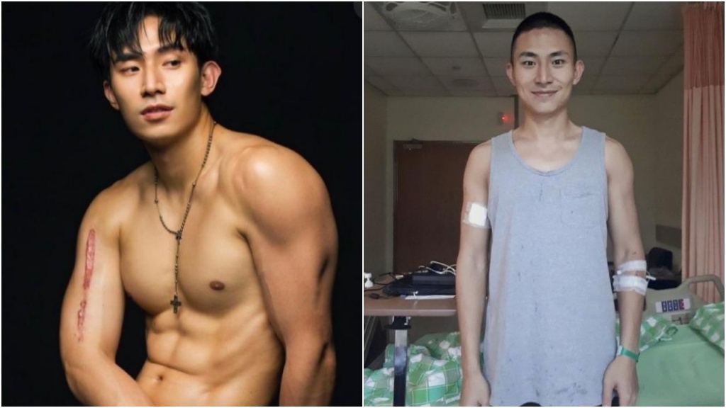 手痛、肩痛竟是癌！男星「骨癌爆肉瘤」險截肢　這裡突起小心了