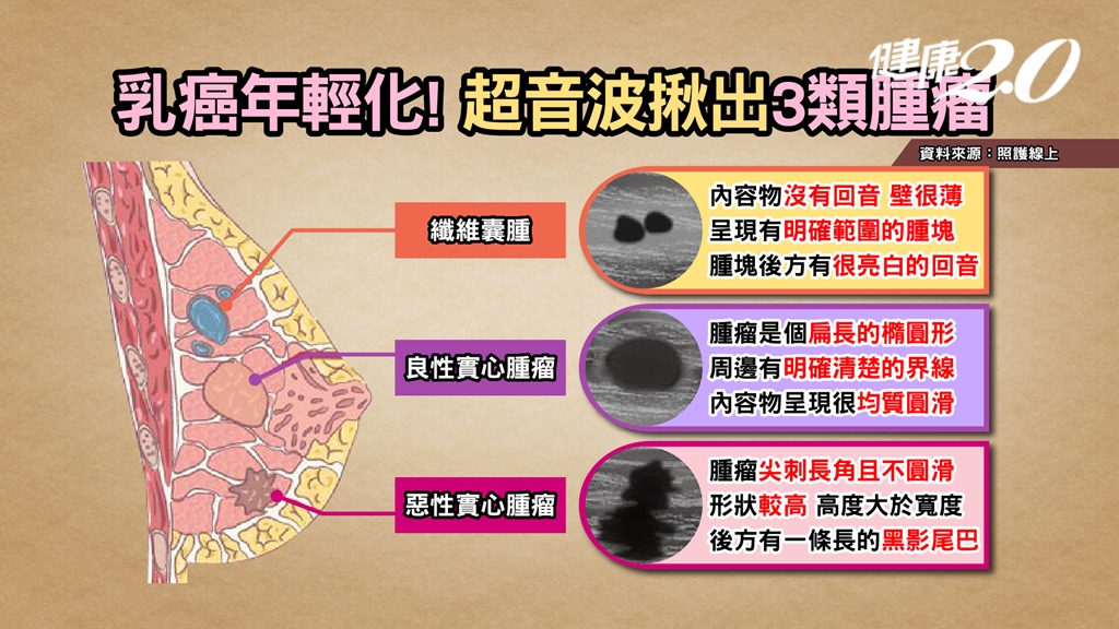 乳癌已經年輕化。（圖／TVBS《健康2.0》）