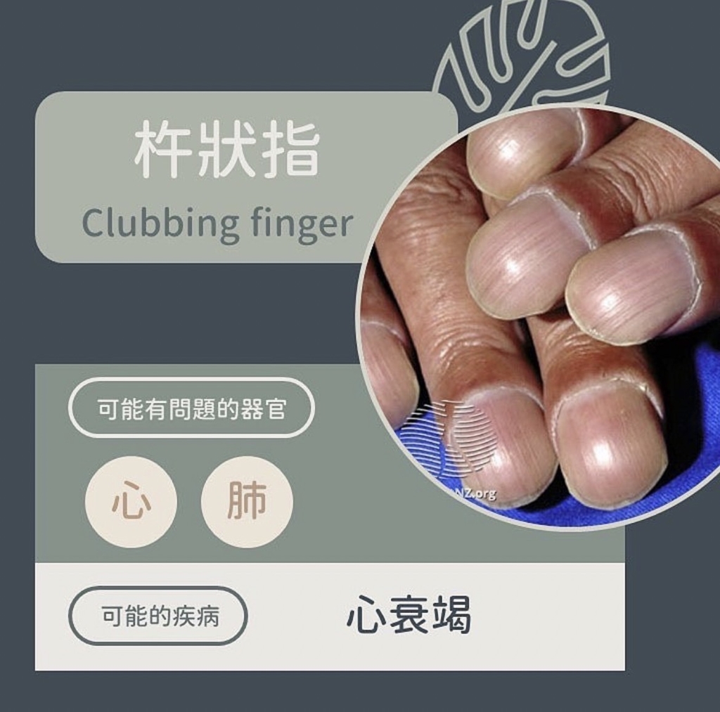 杵狀指異常變化。(圖/翻攝自皮膚科醫師黃晨昊IG)