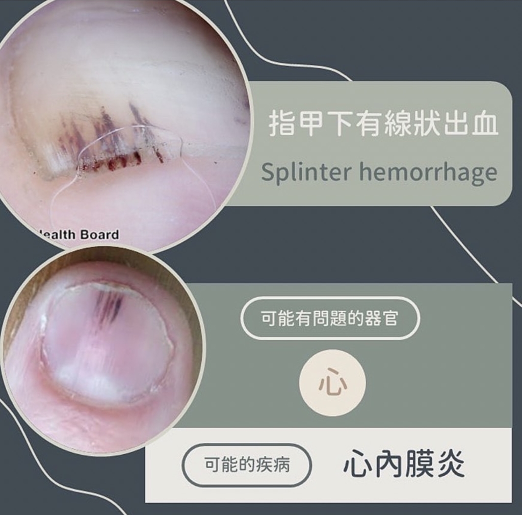 指甲下線狀出血異常變化。(圖/翻攝自皮膚科醫師黃晨昊IG)