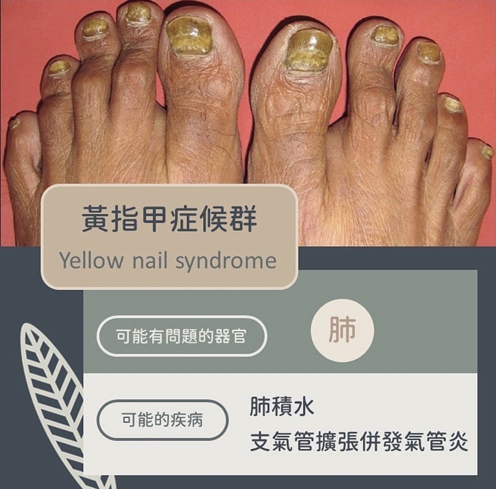 黃指甲症候群異常變化。(圖/翻攝自皮膚科醫師黃晨昊IG)