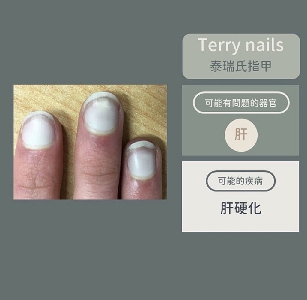 泰瑞氏指甲異常變化。(圖/翻攝自皮膚科醫師黃晨昊IG)