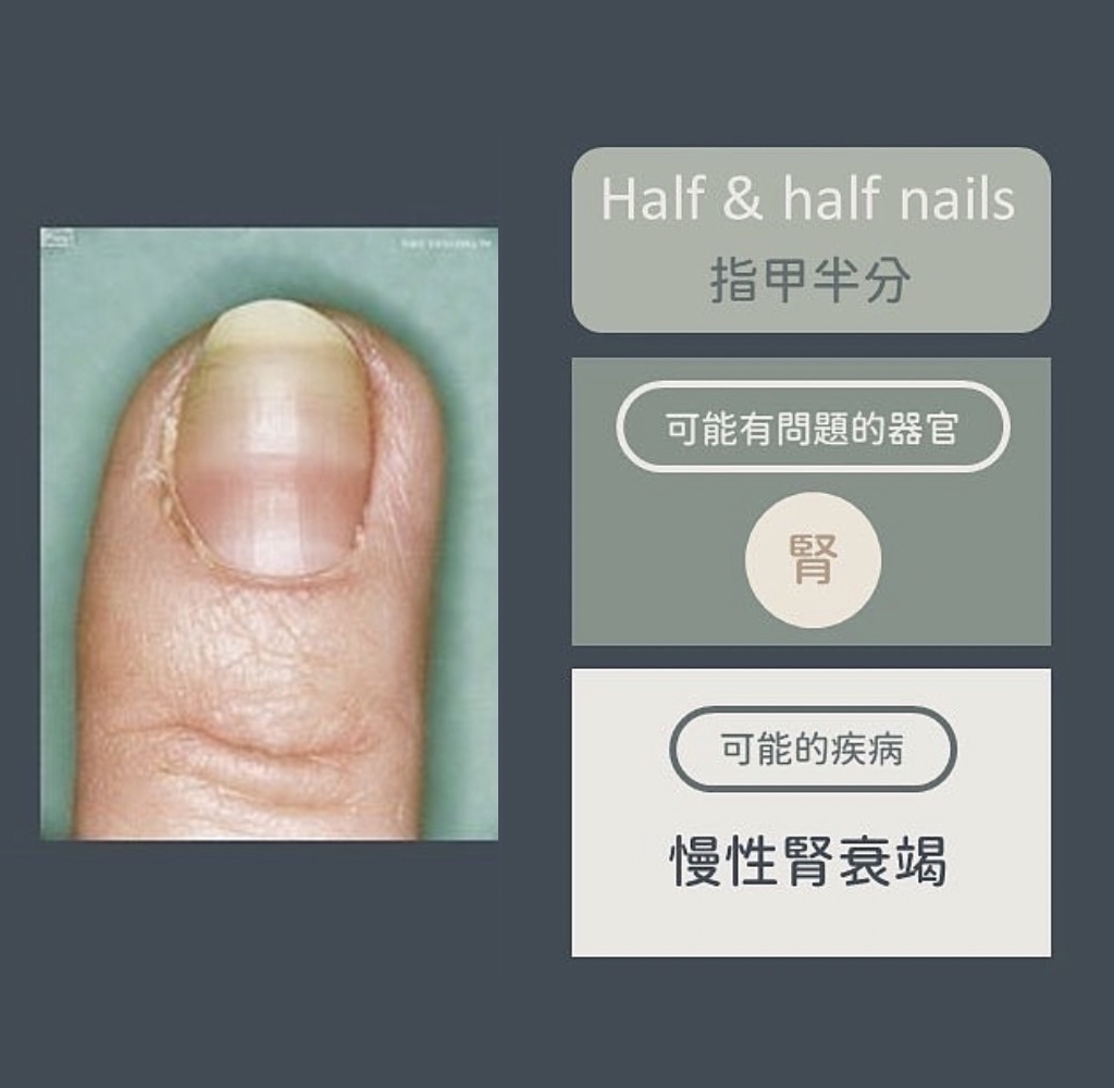 指甲半分異常變化。(圖/翻攝自皮膚科醫師黃晨昊IG)