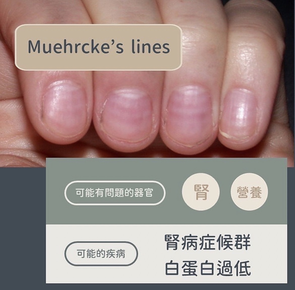 梅爾克氏線異常變化。(圖/翻攝自皮膚科醫師黃晨昊IG)