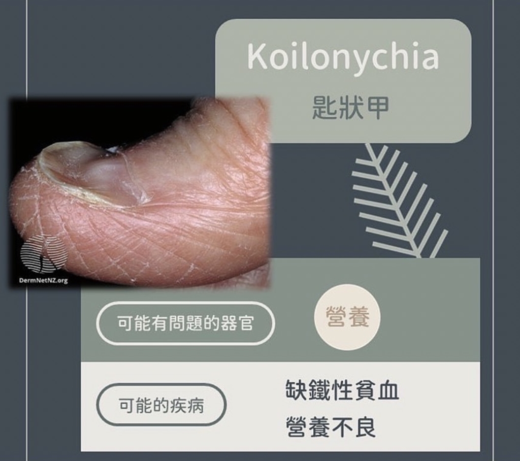 匙狀甲異常變化。(圖/翻攝自皮膚科醫師黃晨昊IG)
