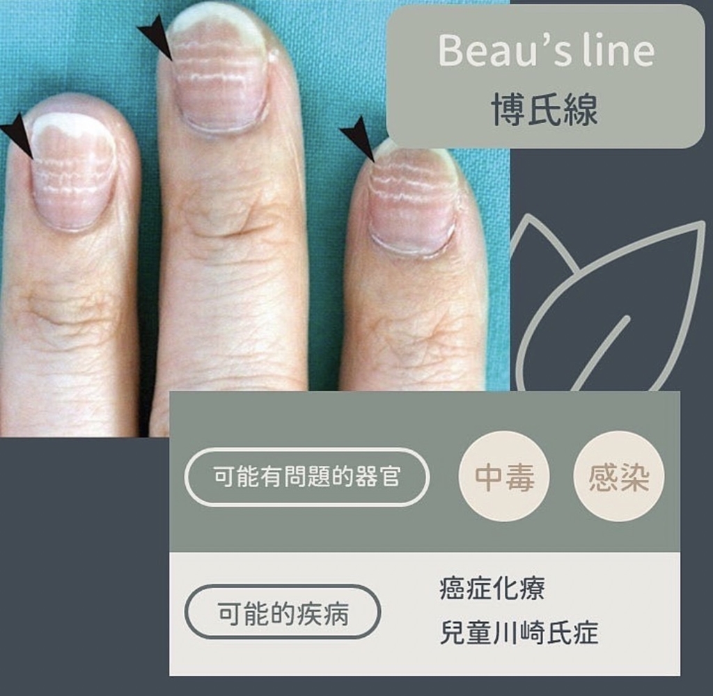 博氏線異常變化。(圖/翻攝自皮膚科醫師黃晨昊IG)