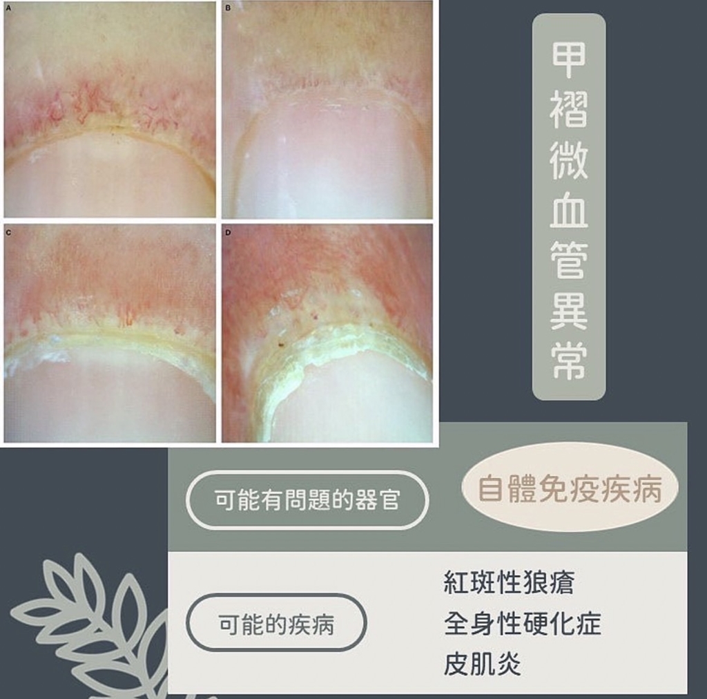 甲褶微血管異常變化。(圖/翻攝自皮膚科醫師黃晨昊IG)