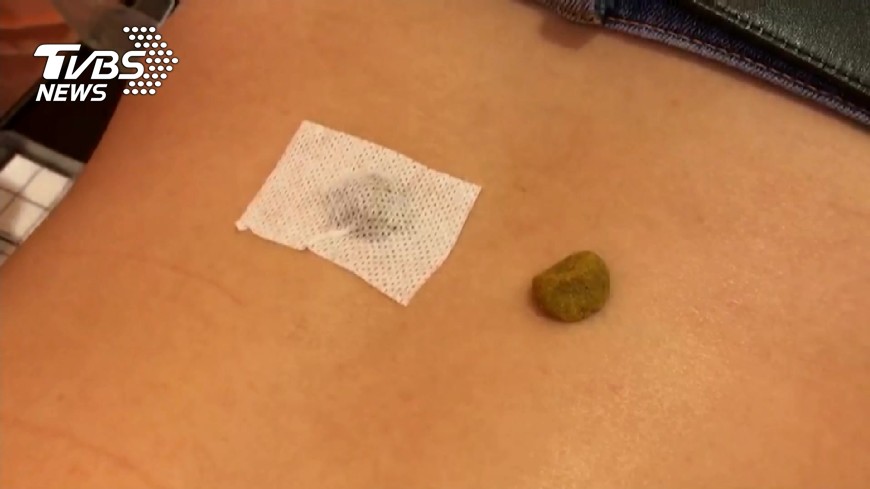 快訊/三伏貼治過敏! 這三天貼效果最顯著
