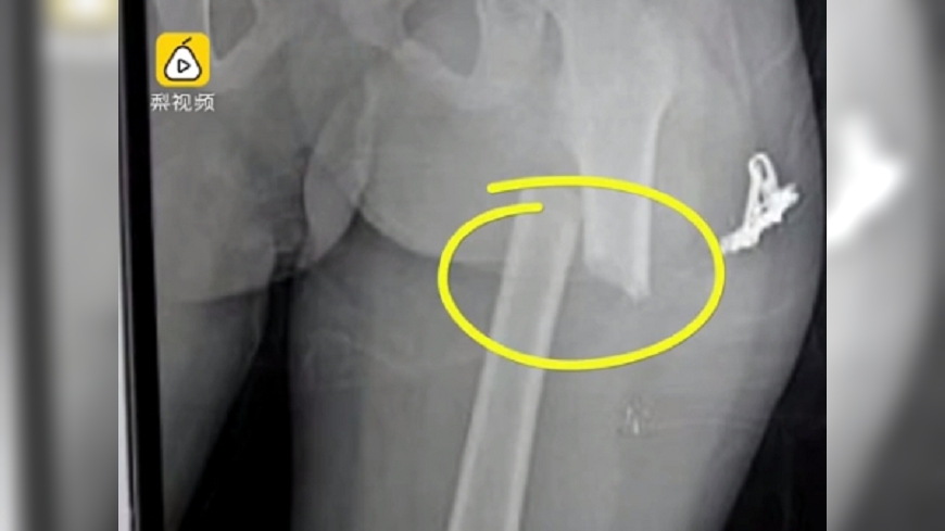 嫌走太慢 老爸一腳踹斷6歲兒大腿骨