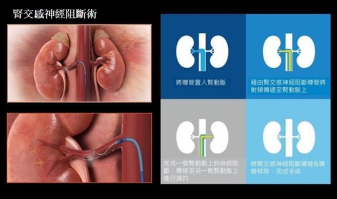 微創腎交感神經療法,是透過導管從大腿股動脈經微創方式置入到腎臟動脈,以低能量射頻在腎動脈適當位置燒灼,阻斷過度活化的交感神經,手術過程會局部麻醉,約30分鐘即可完成。