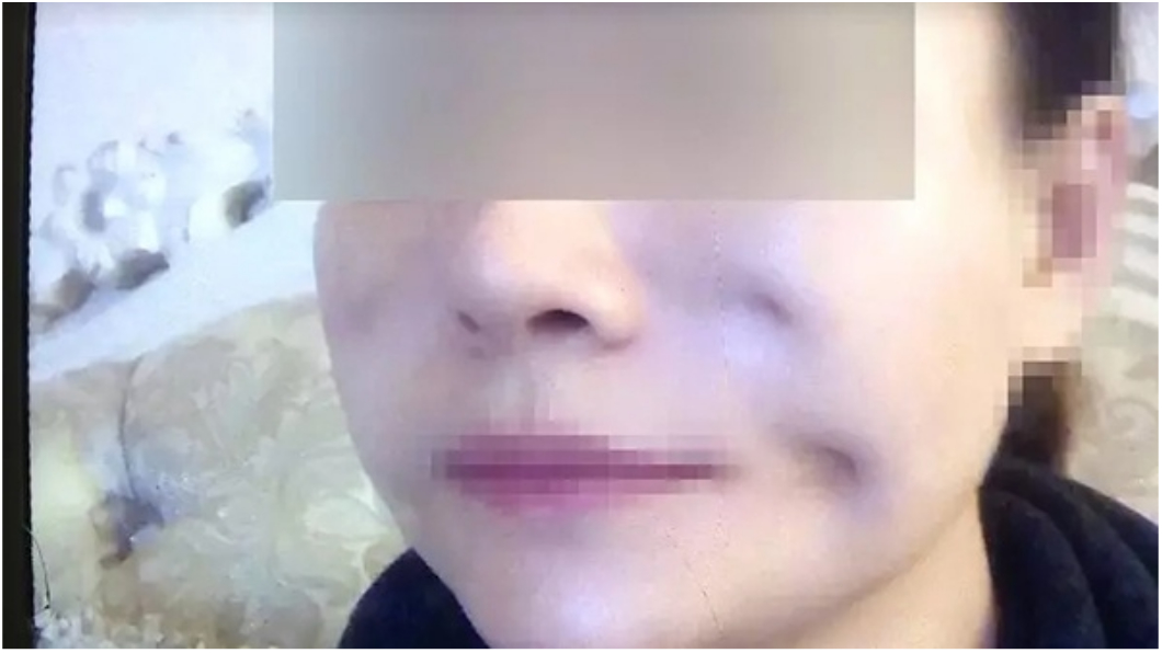 整容臉鑿出「8個坑」!美容機構:要變美先變鬼