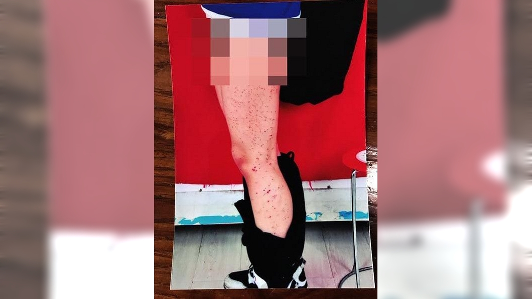 女學生遭同學用筆刺滿腿血孔 校方:開玩笑而已