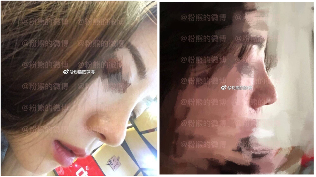 借錢隆鼻才1個月 狠閨密「妳整型喔?」一手壓扁