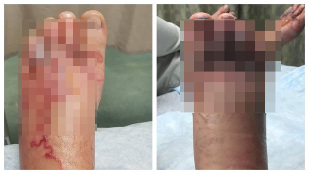 夫妻光腳漫步沙灘遭「入侵」 腳掌紅腫化膿宛如麵龜