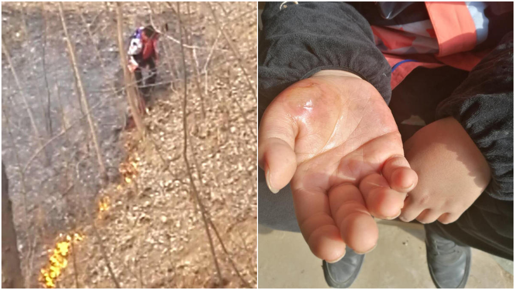 11歲小英雄滅山火！手燙傷硬撐救「怕樹燒死」