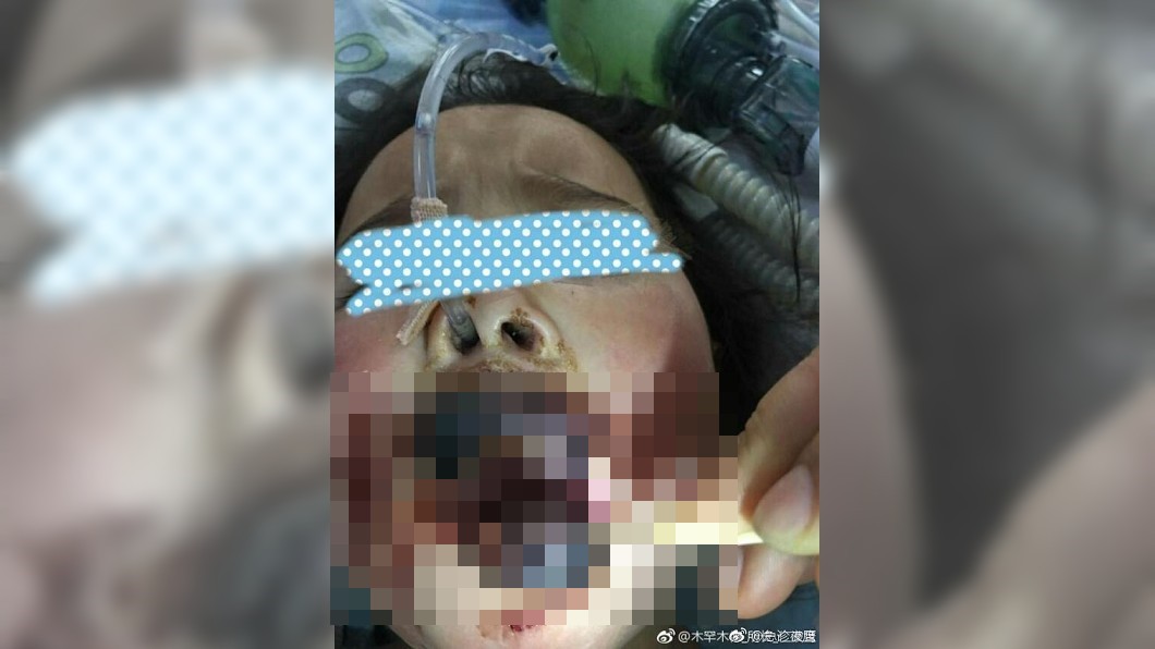悚！女童發燒抽搐　家人「灌滾水」燙爛喉嚨