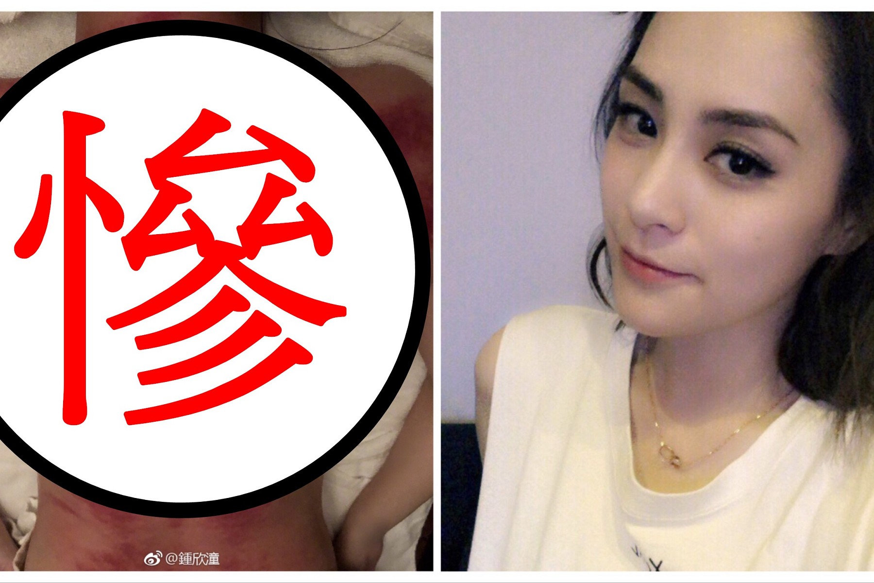 怵目! 準新娘阿嬌曬刮痧血背 網友歪樓關注小蠻腰