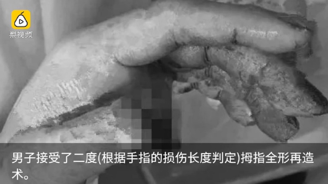 男春節放煙火炸飛手拇指 醫生切斷他腳趾頭接上去