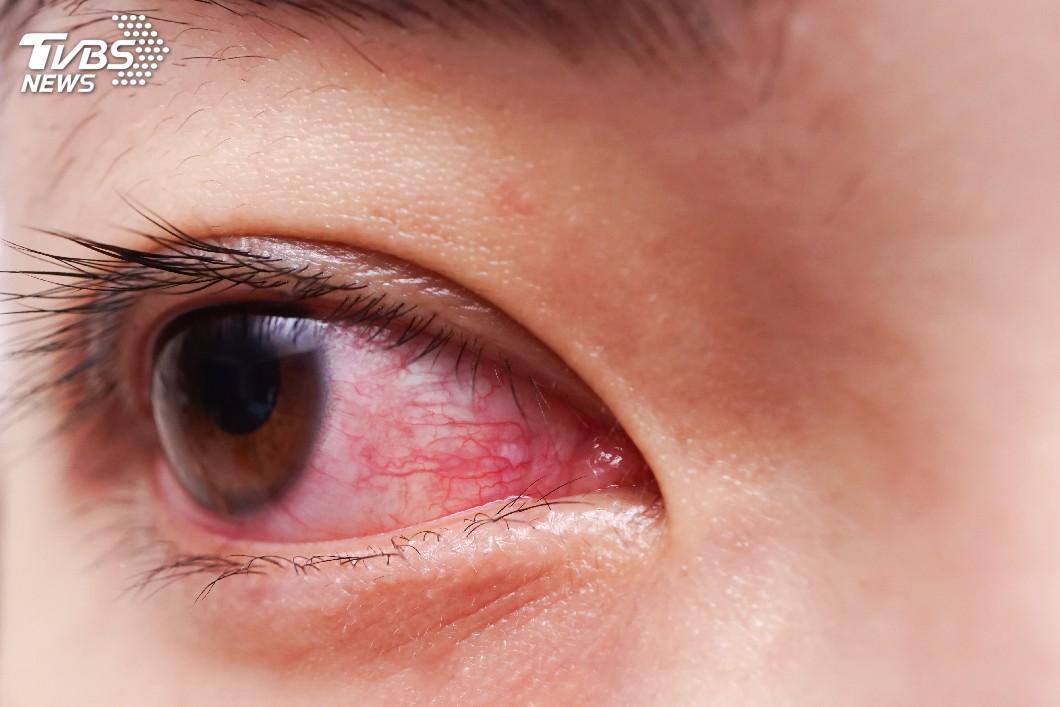 就是有鬆?戴隱形眼鏡爽泡溫泉 角膜竟破洞!