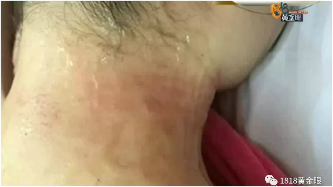 拔罐聞到「烤肉味」　女驚叫：我脖子燒起來了！