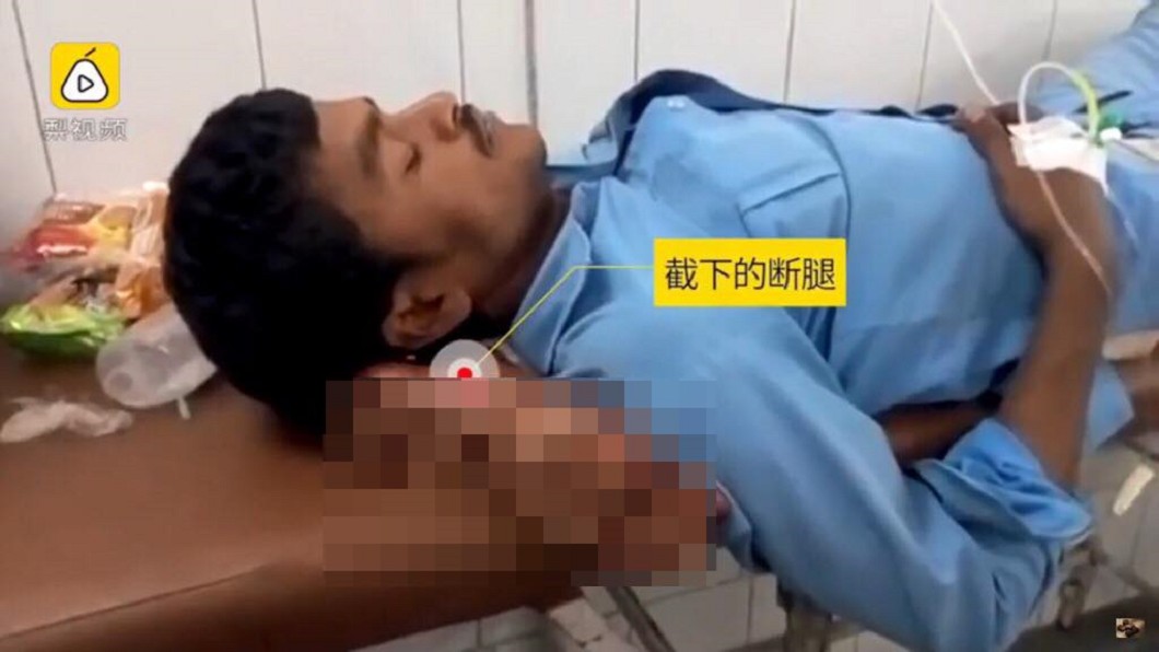 男子車禍截肢 院方竟拿「斷腿」當枕頭