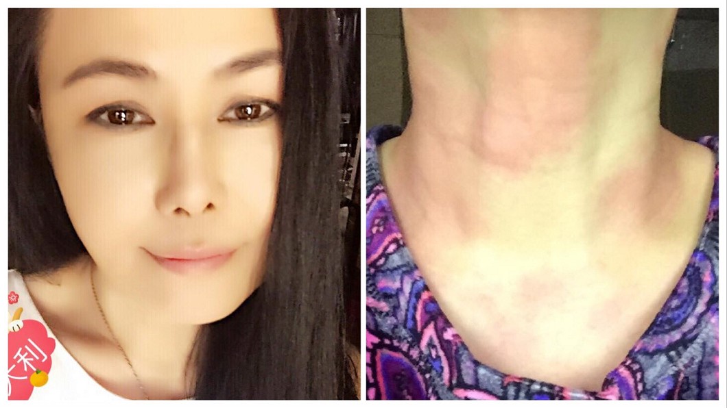 江蕙又掛病號！蕁麻疹染身無奈哀嚎：怕我太閒嗎？