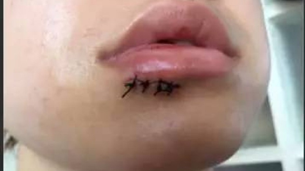 大陸一名女子去年用IKEA玻璃杯喝水突然爆炸，造成門牙斷裂。圖／翻攝自 網易