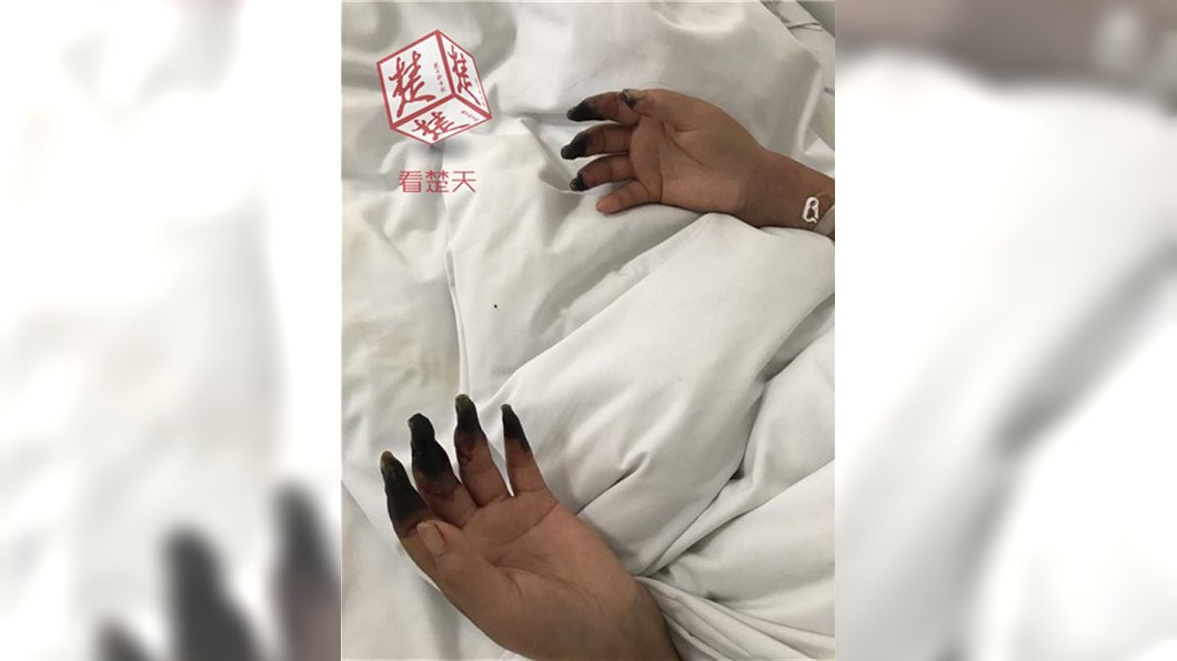 驚!婦做家事弄傷手指 8根指頭焦黑如「枯樹枝」