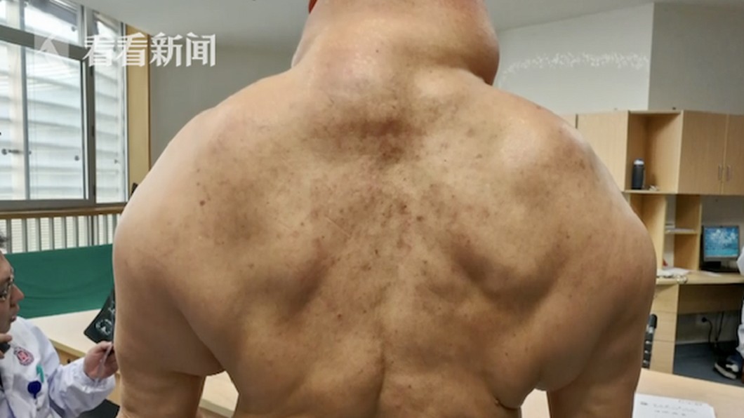 老翁全身長滿脂肪塊，導致身體器官遭壓迫漸漸衰竭。圖／翻攝看看新聞
