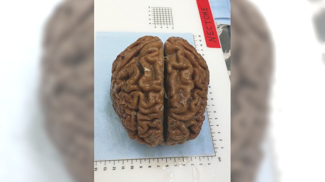 保存大腦記憶或可行 新創公司積極研發