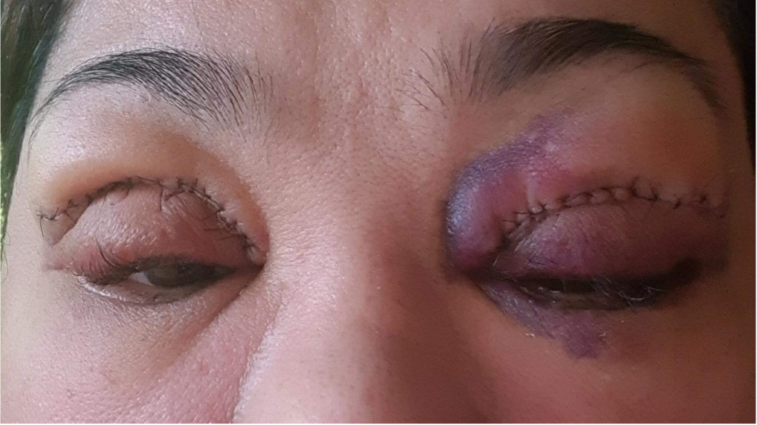 慘!割雙眼皮像被暴打 她腫脹瘀血2個月沒消