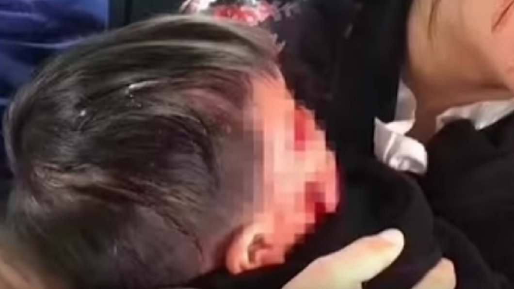 男童遭到惡犬襲擊,導致縫了1百多針。圖/翻攝自《澎湃新聞網》