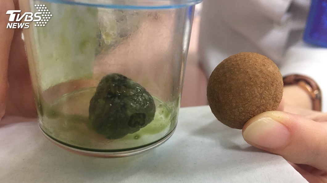 女子忙工作三餐不定　膽結石大如龍眼