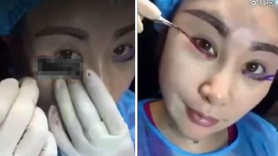 自己割眼瞼!狂女「直播拉皮」 露血色組織:年輕了?