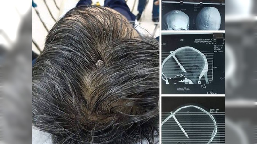 太扯！男頭痛2天就醫　驚見超長釘子插入腦