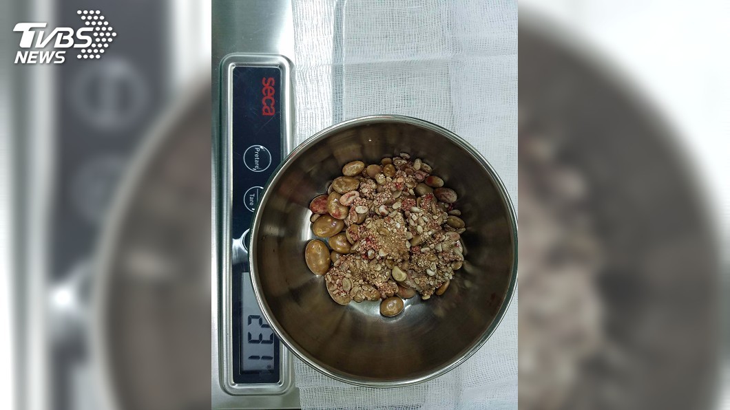 攝護腺肥大! 九旬老翁膀胱結石上百顆