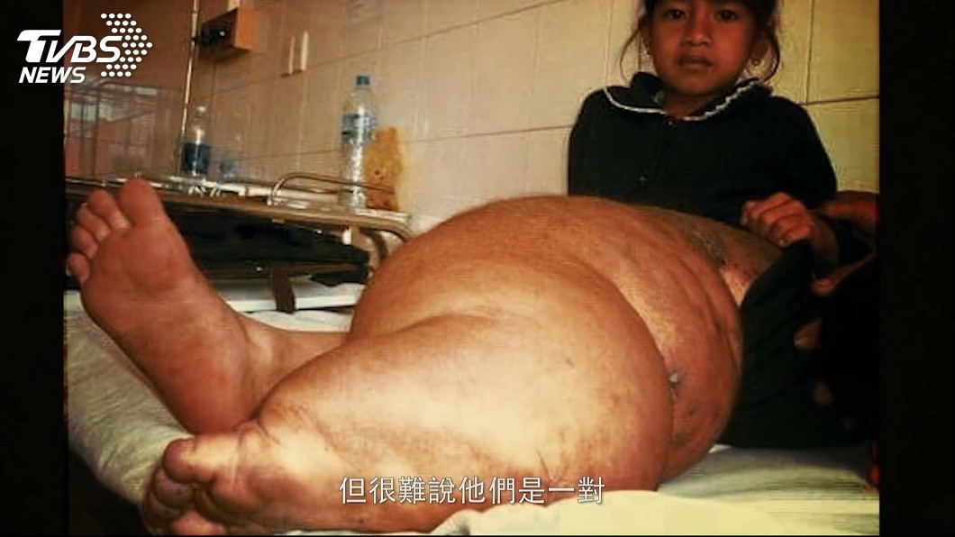 「能走路了」 越南象腿女孩拍微電影謝台灣