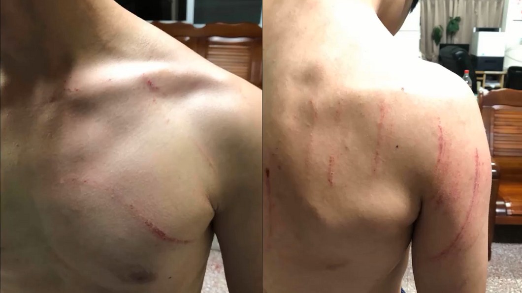 陳男身上多處挫傷,目前陳男與喝醉顧客互告傷害。圖/翻攝自 黑色豪門企業