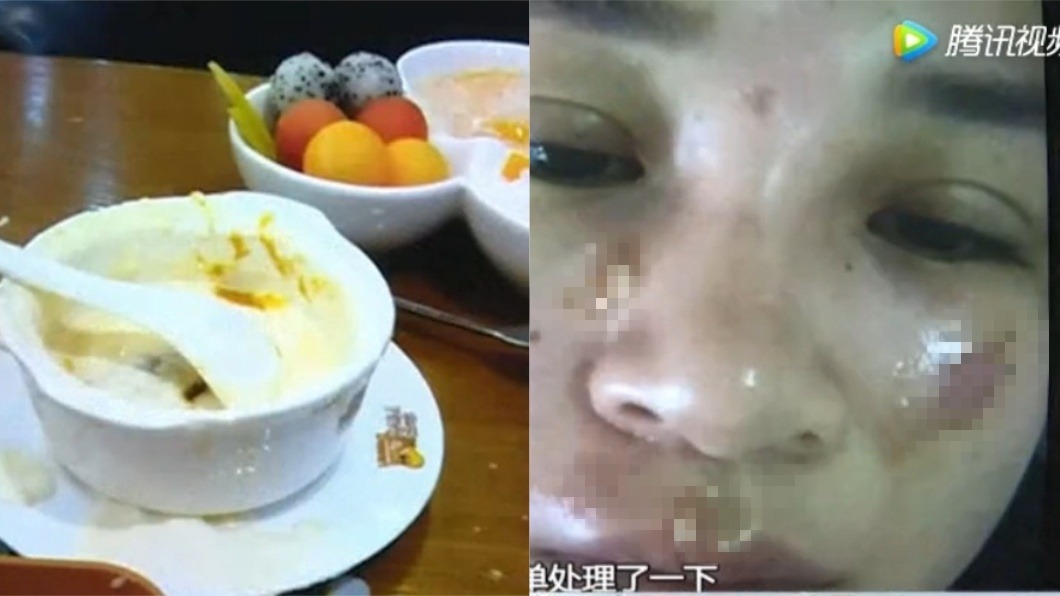 吃甜點也有事!「雙皮奶」嘴邊爆炸 OL險毀容