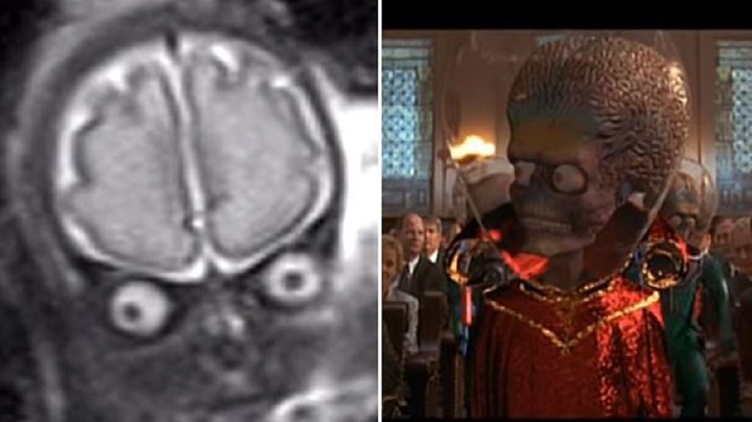 產檢照MRI驚見「凸眼異形」　嫩媽崩潰：懷了火星人？