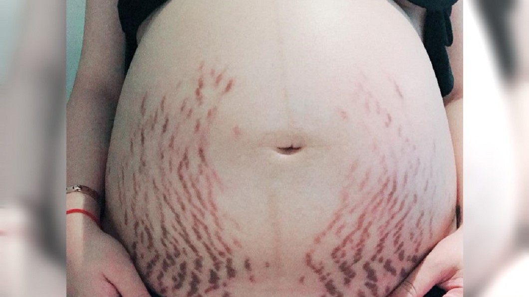 孕婦自卑妊娠紋不好看 老公這句「玩笑話」好暖