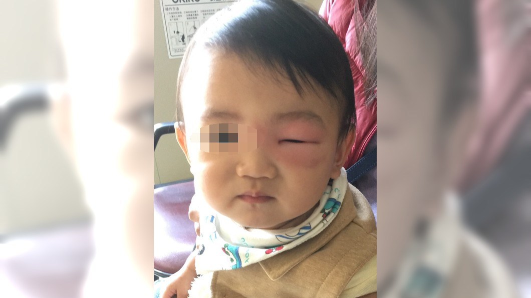 蚊咬腫到看不到雙眼皮 患蜂窩性組織炎