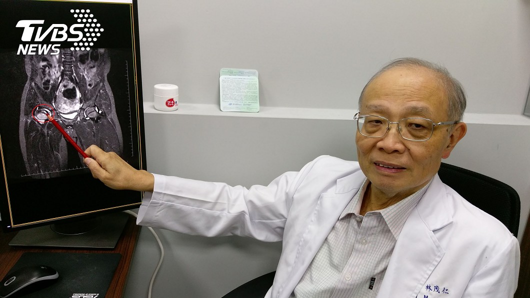 6歲童走路怪異 竟患股骨頭缺血性壞死