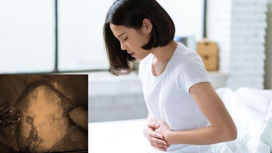 女大生經痛「子宮硬如石頭」是吃冰造成？醫：大錯特錯